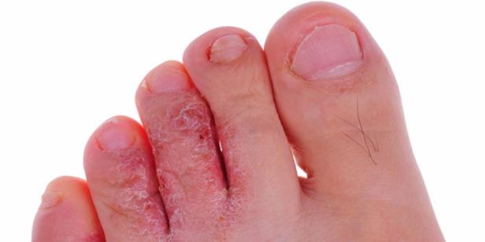 Cómo Tratar Los Hongos En Las Uñas De Los Pies Ciencia Y Salud Diario La Prensa
