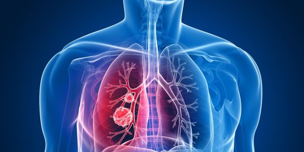 La innovación que revoluciona el modo de tratar el cáncer de pulmón 