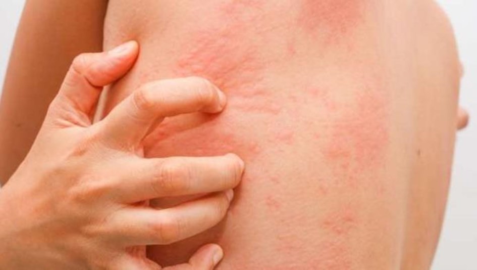 La picazón como síntoma de un estado psicológico Ciencia y Salud