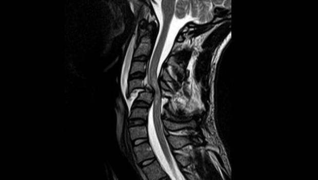 Lesiones medulares por traumatismo: ¿qué exámenes no deben demorarse?