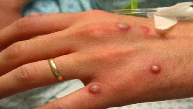 Viruela del mono: el posible vínculo no reconocido con el covid