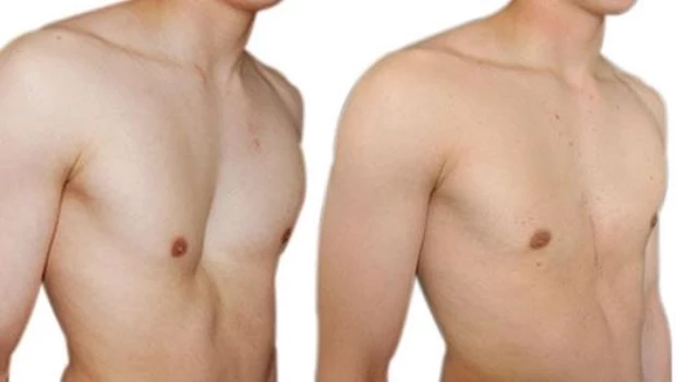 Grandes avances en la cirugía que resuelve el pecho hundido