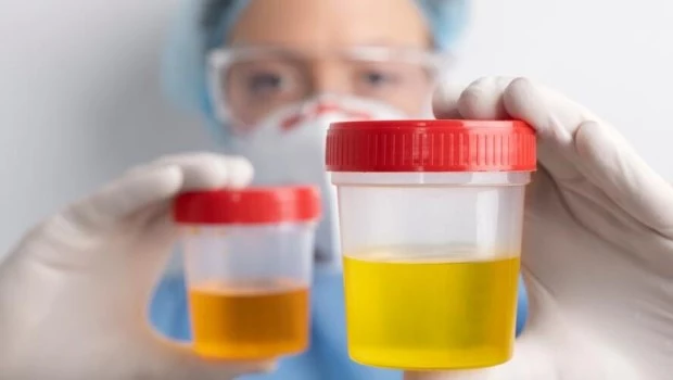 Los colores de la orina: ¿qué es normal y qué no?