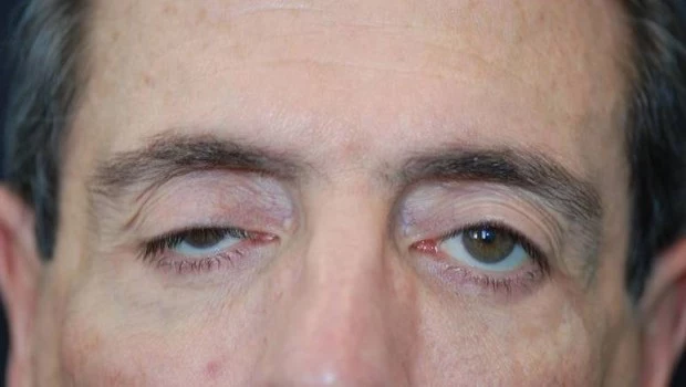 Miastenia gravis: la importancia de un diagnóstico rápido y preciso