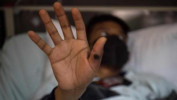 Suecia comunicó el primer caso de la viruela del mono fuera de África