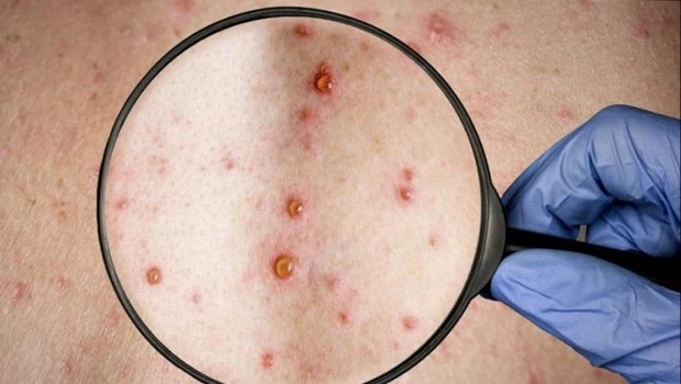 Se detectaron más de 20 casos de viruela símica en Argentina
