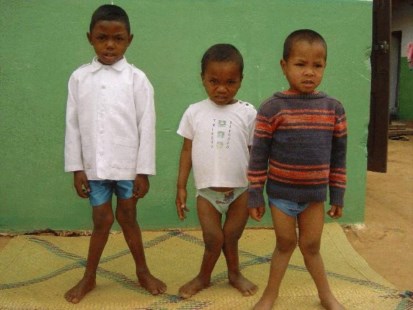 Hay 200 millones de niños con raquitismo