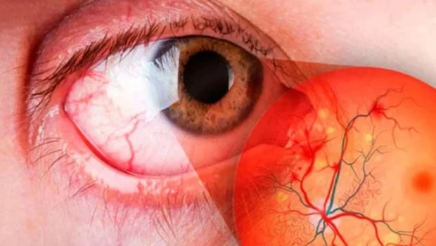 Se llevará adelante la Campaña Nacional de prevención de ceguera por diabetes