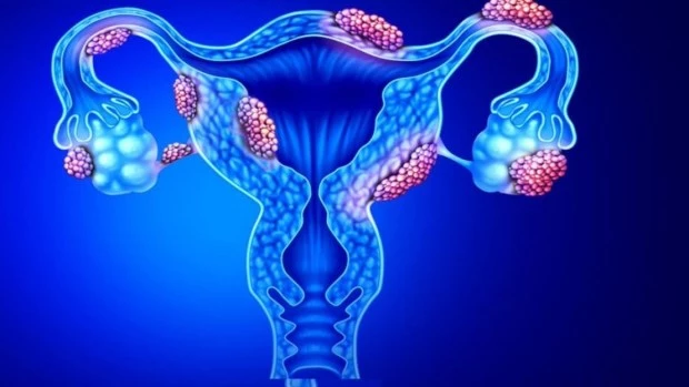 La mitad de las mujeres con dificultades para concebir padece endometriosis