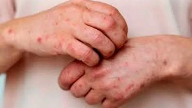 Córdoba: se confirmaron dos nuevos casos de viruela símica