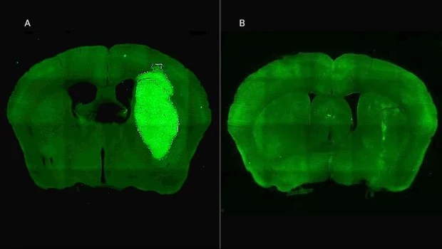 Logran frenar un tipo de cáncer cerebral con una novedosa estrategia terapéutica