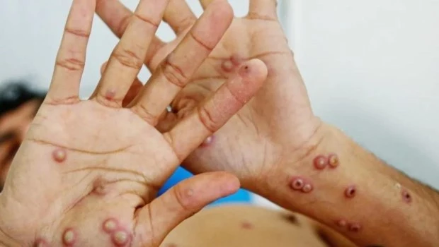 Confirman un caso de viruela símica de la variante más contagiosa