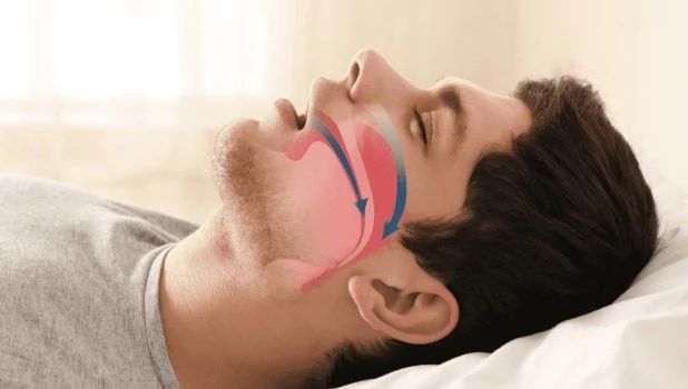 Las apneas de sueño y su impacto en la salud