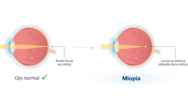 Miopía en niños y adolescentes: ¿es posible prevenirla?