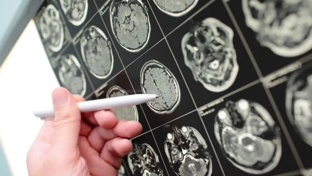 Tumor cerebral: una enfermedad invisible que exige diagnóstico temprano y acceso igualitario
