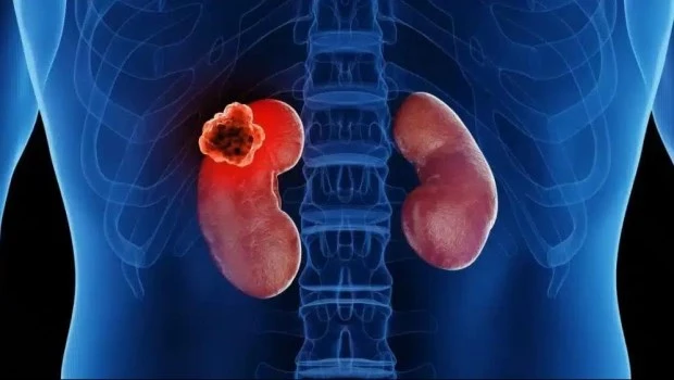 El cáncer de riñón causa más de 2.300 muertes al año en el país