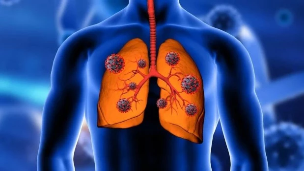 Fibrosis quística: nuevos tratamientos están transformando el pronóstico de la enfermedad
