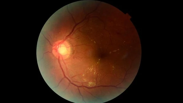 Retinar: inteligencia artificial para prevenir la pérdida visual en personas con diabetes