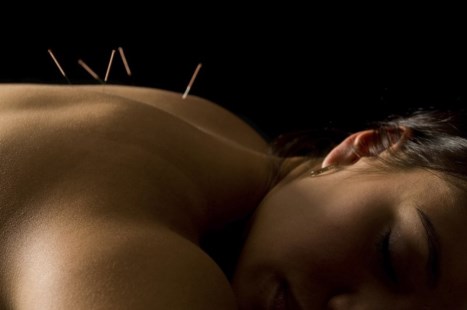 Acupuntura: de la tradición china al consultorio médico