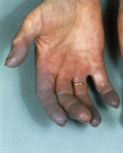 Esclerodermia: cuando la advertencia se tiñe de azul 