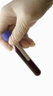 Hepatitis: un análisis de sangre puede cambiar su futuro