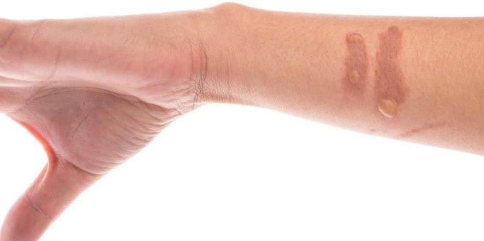 Qué hacer ante una quemadura menor - Ciencia y Salud | Diario La Prensa