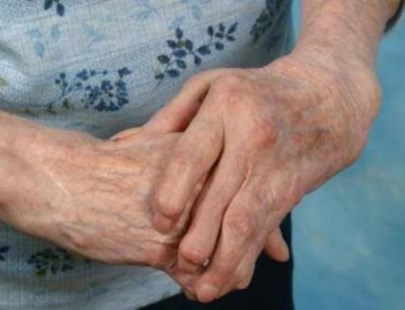 reumatism autoimun de ce doare genunchii